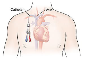 Port or PICC Line Placement - Vein & Endovascular Medical Care