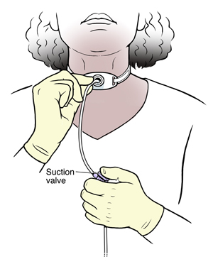 Woman inserting suction catheter into tracheostomy tube in neck.