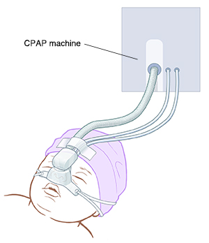 Closeup of baby's head showing CPAP mask and machine.