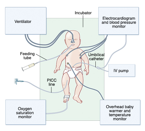 Nicu best sale meaning medical