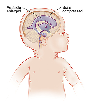 Human Child Skull, Hydrocephalic