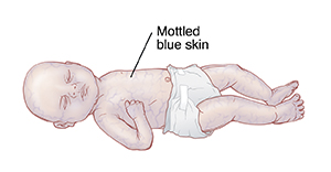 Skin Color Changes In The Newborn Saint Luke s Health System