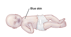 Baby with blue skin.