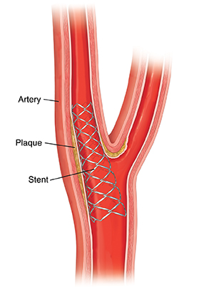 Having Carotid Artery Stenting | Saint Luke's Health System