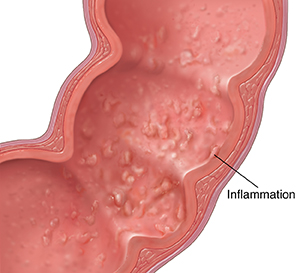 Ulcerative Colitis