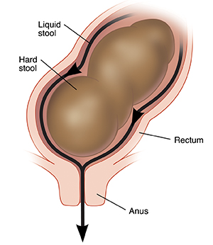 When Your Child Has Encopresis Saint Luke s Health System