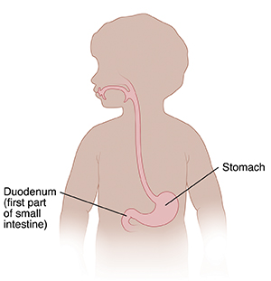 When Your Child Has a Gastric or Duodenal Ulcer