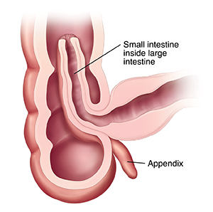 Cross section of intestine showing intussusception.