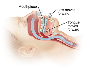 Mouth Guards for Sleep Apnea: Pros & Cons