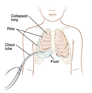 About Your Chest Tube Placement Procedure