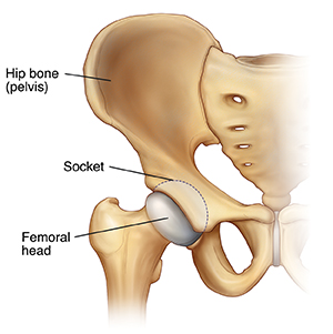 Minimally invasive surgery in a total hip replacement