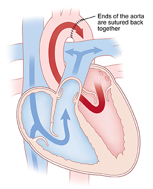 Cross section of heart showing repair of coarctation of the aorta.