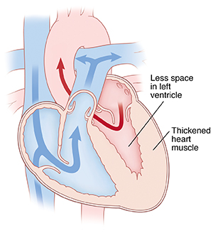 Cross section of heart with hypertrophic cardiomyopathy.