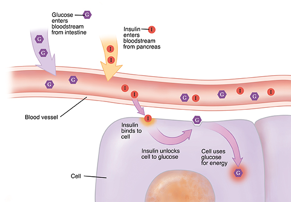 insulin diabetes type 1