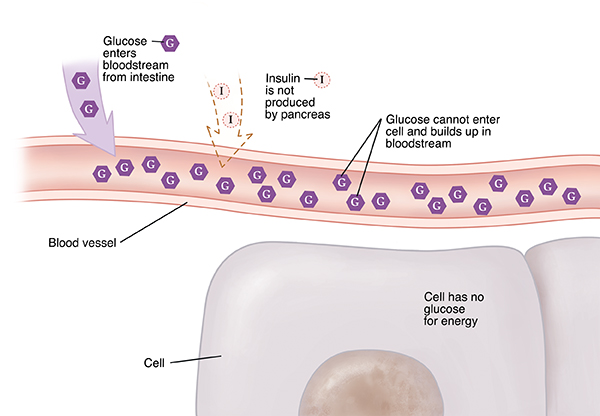 insulin diabetes type 1