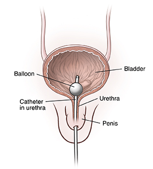 Front view of penis showing cross section of bladder and urethra showing catheter inserted through urethra into bladder.