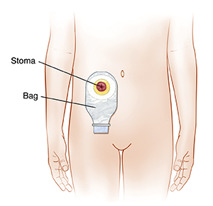 When Your Child Needs a Stoma