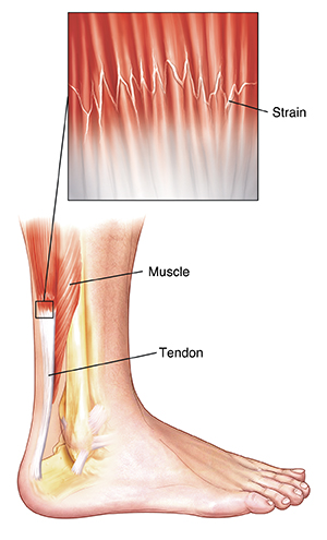 Healthy Street - CALF STRAIN AND HOW TO FIX IT A calf strain is a tear of  the muscle fibres of the muscles at the back of the lower leg and can