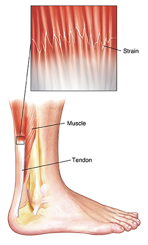 Healthy Street - CALF STRAIN AND HOW TO FIX IT A calf strain is a