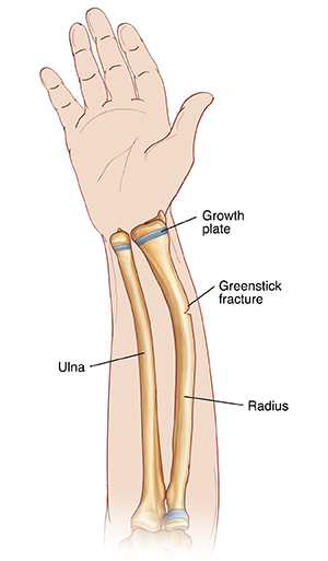 Palm view of hand and forearm showing radius and ulna. Greenstick fracture goes partway through radius. Growth plates are near wrist.