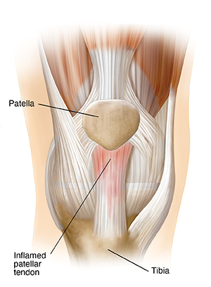 Patellar Tendonitis, Jumper's Knee Treatments