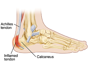 Calcaneus pain 2025 after running