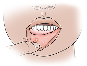 How to Get Rid of a Canker Sore ASAP, According to Experts