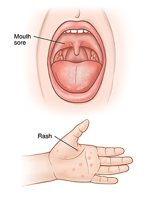 Hand, foot, and mouth disease in adults: Symptoms and treatment
