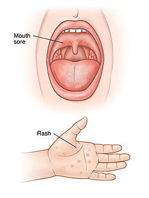 Sores in mouth and deals sore throat