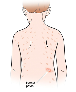 When Your Child Has Pityriasis Rosea