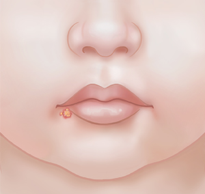 Closeup of mouth showing blister on lower lip.