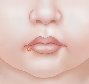 When Your Child Has Cold Sores