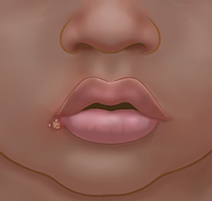 Closeup of mouth showing blister on lower lip.