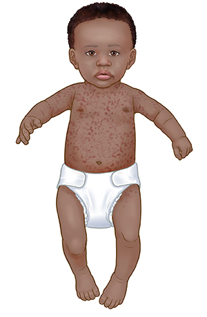 Roseola (Sixth Disease) Symptoms & Causes