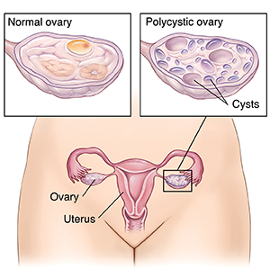 What Your Teen Should Know About Ovarian Cysts