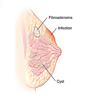 Common Breast Conditions in Teens