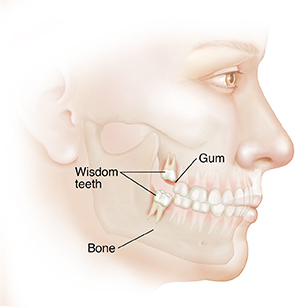 Understanding Wisdom Teeth Saint Luke s Health System