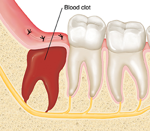 wisdom teeth removal aspendale