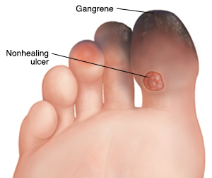 Leg Artery Emergencies: Critical Limb Ischemia (CLI)