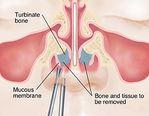 Nasal Surgery Turbinate Surgery Saint Luke s Health System