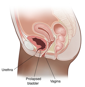 Prolapsed Bladder Symptoms, Causes and Treatment