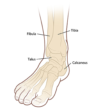 Understanding Ankle Fusion | Saint Luke's Health System