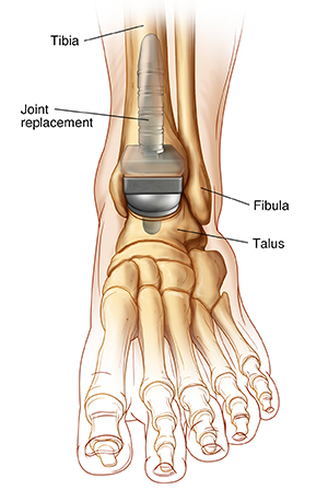 The artificial ankle joint