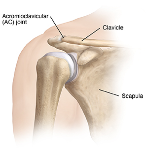 Acromioclavicular (AC) Joint Separation Repair - The Institute for