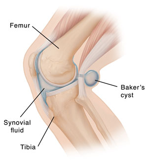 One case of wrist cyst rupture with nerve and blood vessel