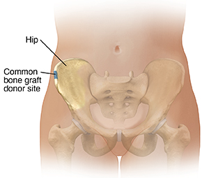 Having a Bone Graft  Saint Luke's Health System