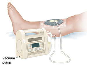 Negative Pressure Wound Therapy