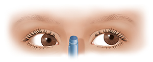 Front view of child's eyes with convergence insufficiency.