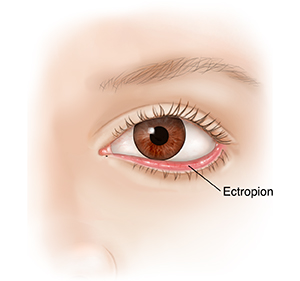 Lower eyelid deals pain