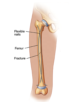 Understanding Femur Fracture Open Reduction and Internal Fixation